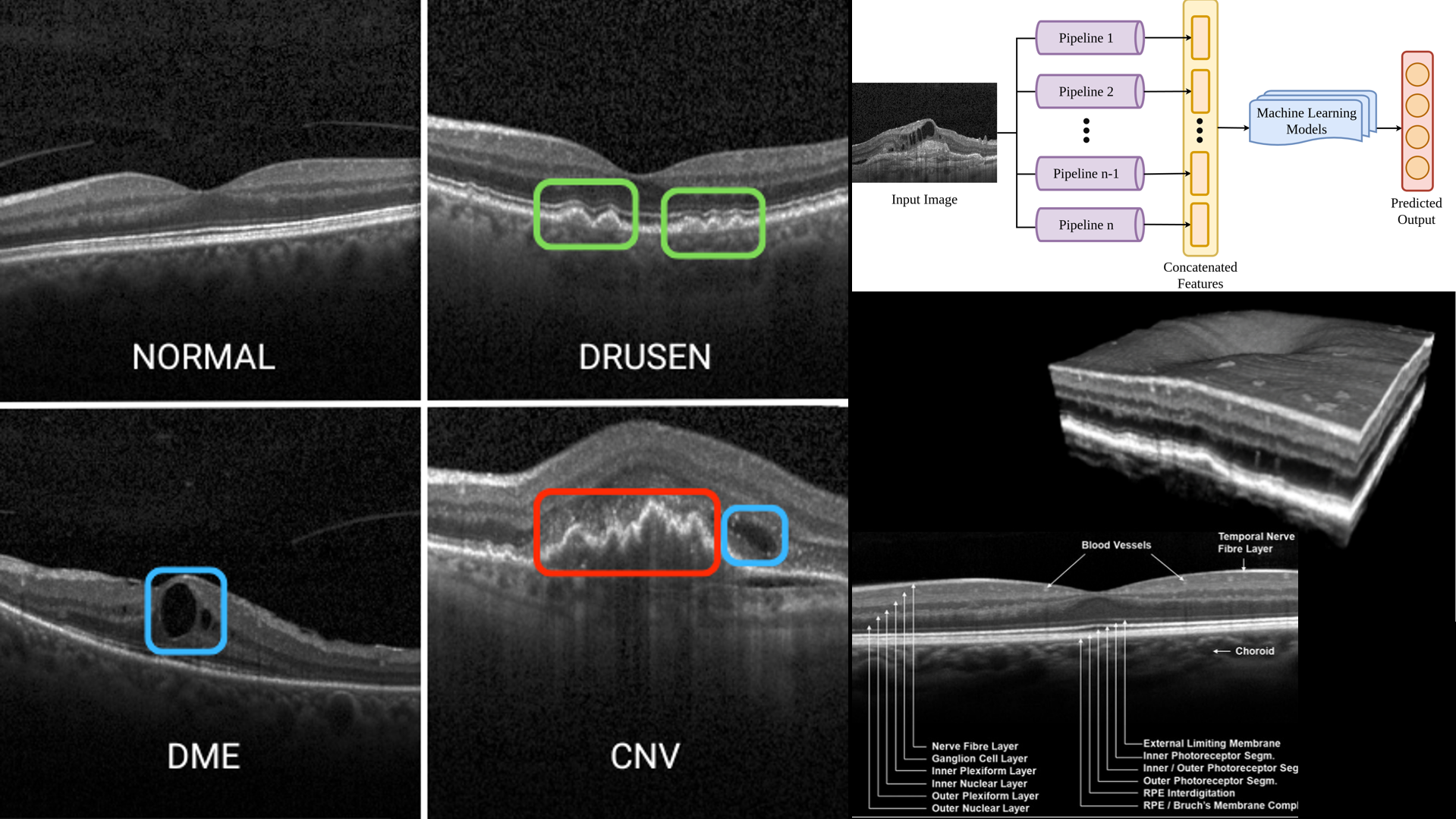 Retinal OCT